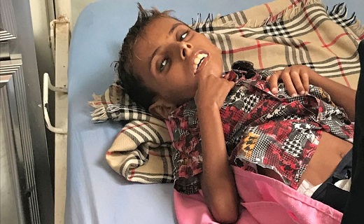 يونيسف: وفاة طفل يمني في الحديدة نتيجة نقص التغذية الحاد