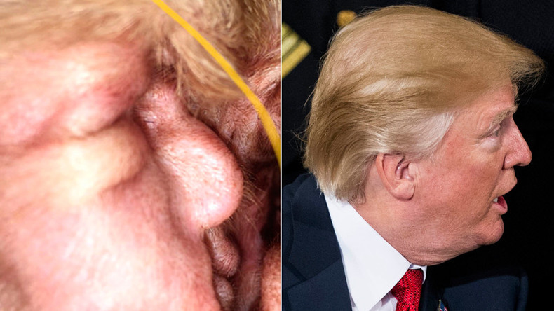 Dog-owner finds cyst in beagle’s ear with uncanny resemblance to Donald Trump