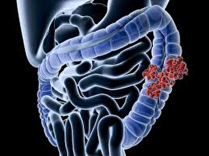 Colon cancer may be metastatic long before initial detection