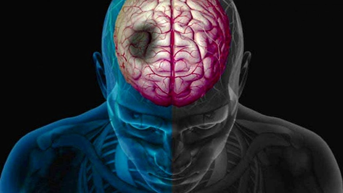 تفاوت سکته ایسکمیک و خونریزی و علائم سکته مغزی + فیلم
